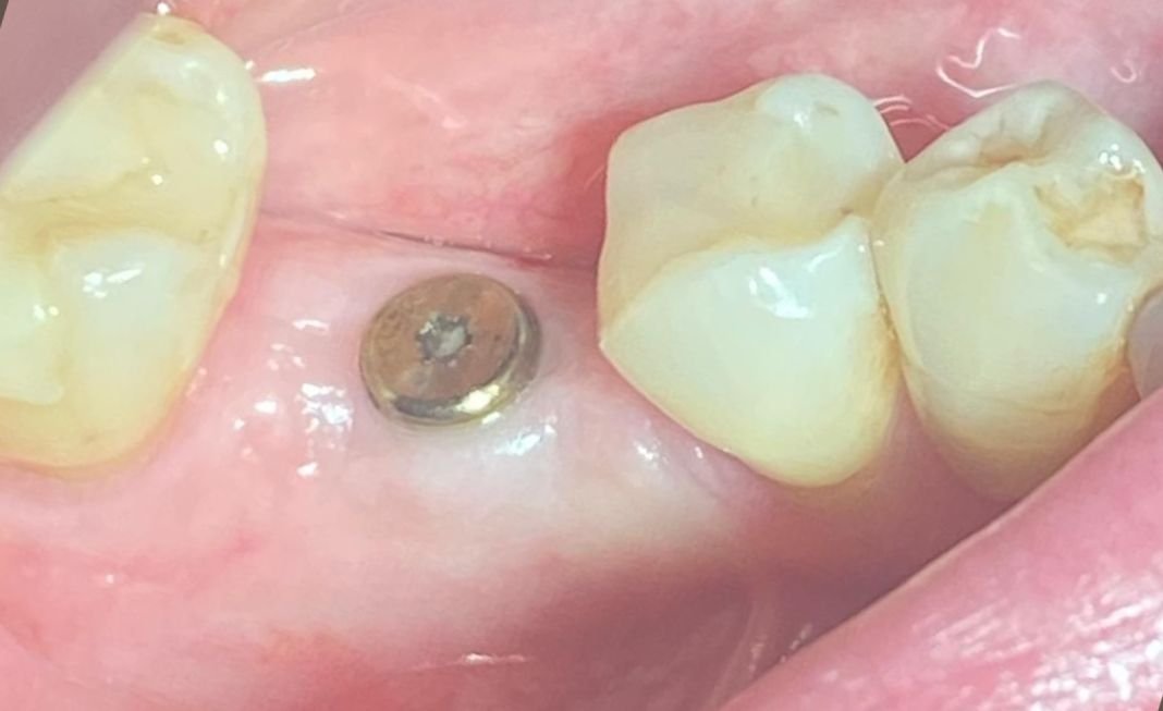 implanty dentysta gdynia implanty dentysta gdynia