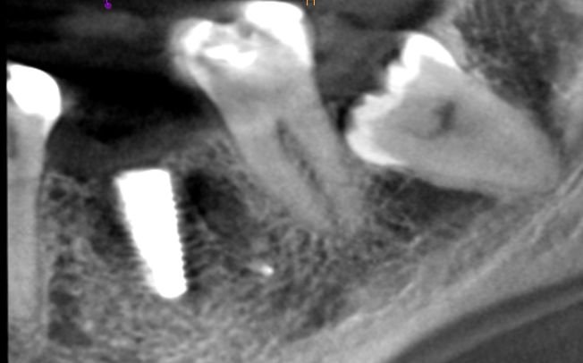 You are currently viewing Implanty dentysta Gdynia